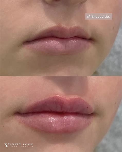 How to Know If You Have M-Shaped Lips — Vanity Look Skin Center