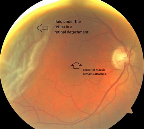 Detached Retina Symptoms