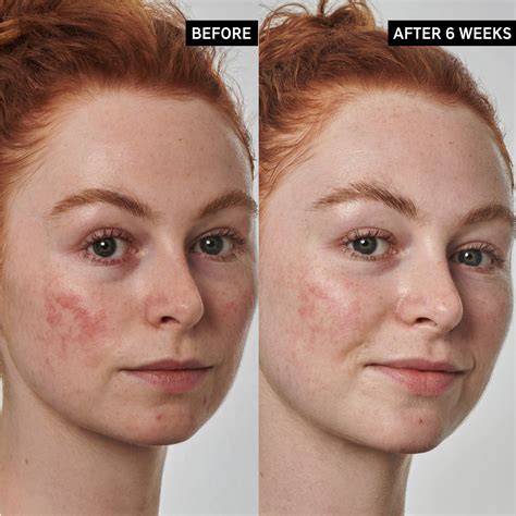 The INKEY List UK Azelaic Acid 10% for Redness Relief