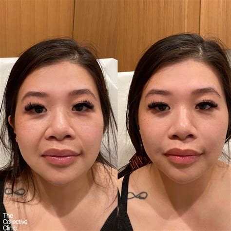 Smile Line Filler | Before & After — The Collective Clinic