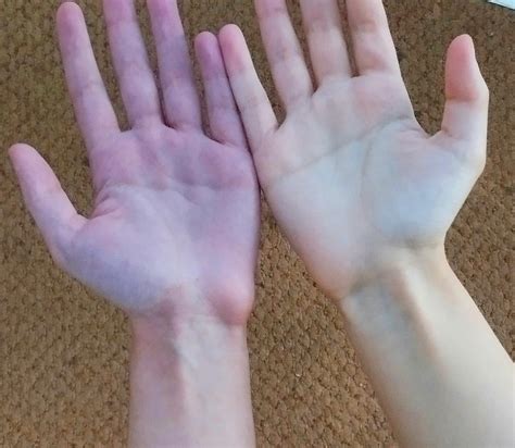 Welp... My blood pooling is awful : r/dysautonomia