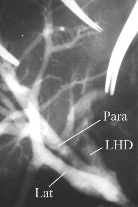 Bile Duct of Luschka Connecting with the Cystohepatic Duct: The ...