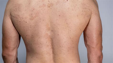 Understanding Pityriasis Rosea: All Your FAQs Answered - Sparsh Skin Clinic