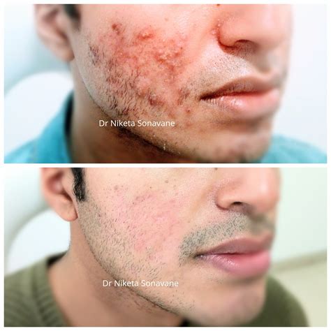 Cystic Acne Scars