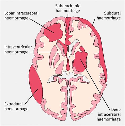 Brain Hemorrhage | Intracranial hemorrhage, Subarachnoid hemorrhage ...