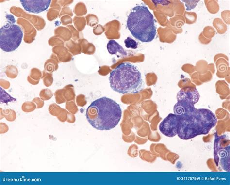 Erythrophagocytosis Cartoons, Illustrations & Vector Stock Images - 11 Pictures to download from ...