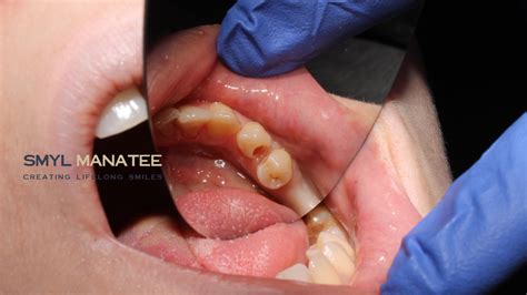 Front Tooth Cavity Filling: Procedure, Cost, and Best Care Practices