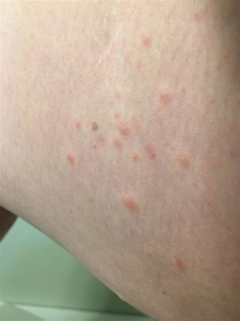 Cluster of raised bumps on inner thigh. Not itchy. Any ideas? : r/DiagnoseMe