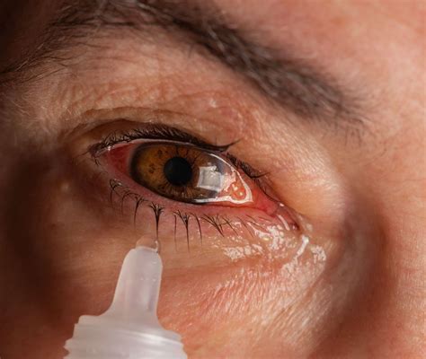 Pink Eye Eye Drops: Treatment and Prevention