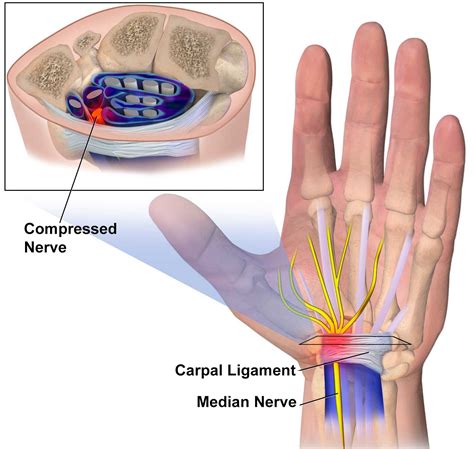 Carpal Tunnel Syndrome X Ray at Tracy Mcfall blog