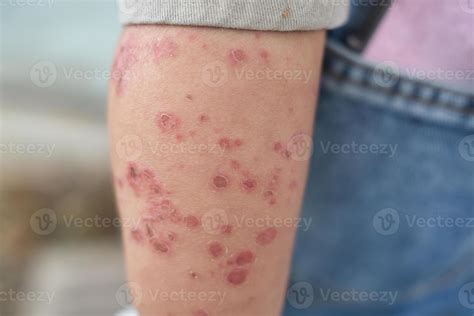Hand foot and mouth disease a rash of painful blister and dry scaly rash on child leg 54525223 ...