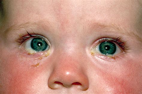 What Do You See? A Refresher on Diagnosing Conjunctivitis - Advances in ...