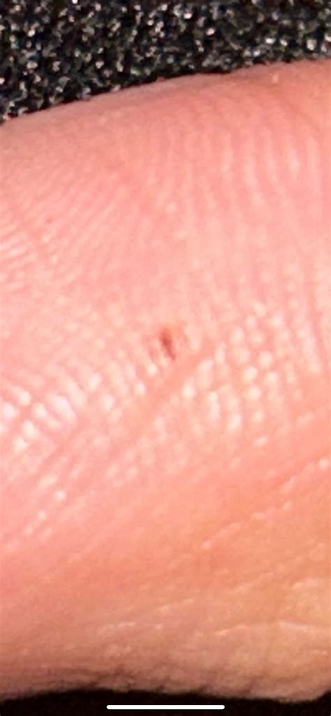 Melanoma Finger at Sarah Kilgore blog