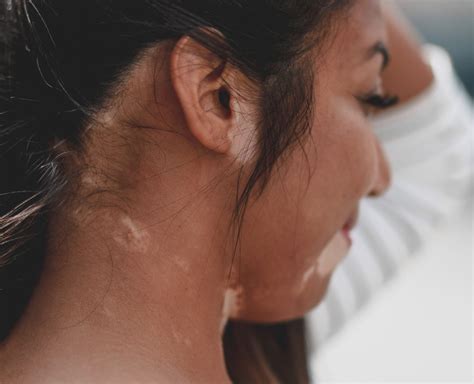 5 Types of Vitiligo and What They Mean | Living Dappled