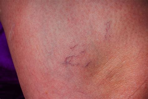 What Does A Rash Look Like From Liver Disease - Infoupdate.org