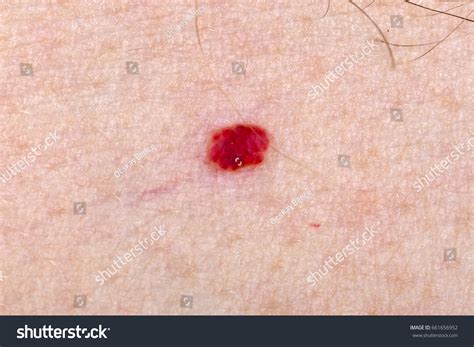 Close Photo Cherry Angioma On Human Stock Photo 661656952 | Shutterstock