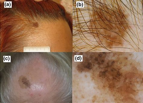 Signs Of Skin Cancer Scalp at Jonathan Landseer blog