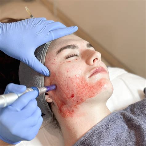 Unlock the Power of PRP Treatment at Mysa Clinic Bali: Your Path to Revitalization - Mysa Clinic