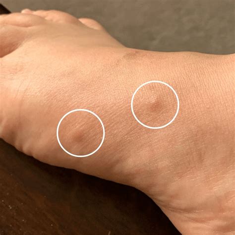 Why Do I Have White Itchy Bumps On My Feet at Daniel Gilmore blog