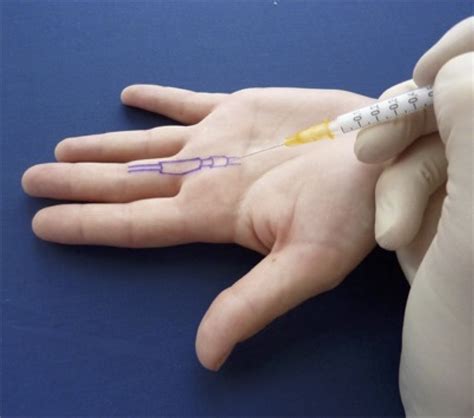 What is Trigger Finger? Causes, Symptoms and Treatment - Korehab Clinic - Orthopedic Surgery ...