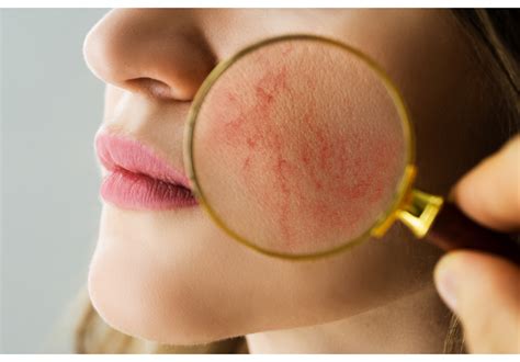 Anfangsstadium von Rosacea erkennen & behandeln