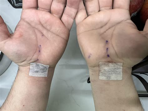 Carpal Tunnel Surgery Recovery Time