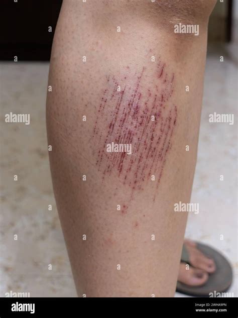 Bruises hi-res stock photography and images - Alamy