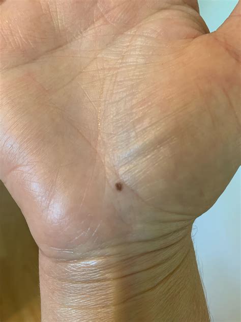 This showed up a few years ago on the palm of my hand. I had it checked out and was cleared. The ...
