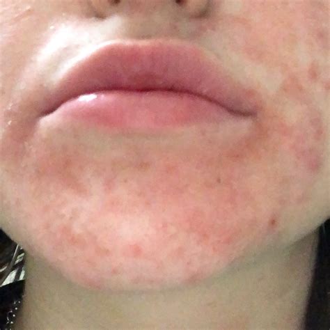 Dermatitis (ICD-10: L20-L30) - Online consultation AI dermatologist