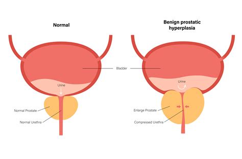 Managing Benign Prostatic Hyperplasia: Your BPH Treatment Options | University of Utah Health