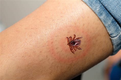 Pfizer's Lyme Disease Vaccine Enters Phase 3 Trial | medtigo