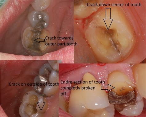 Broken Amalgam Filling Dangerous at Raymond Niles blog