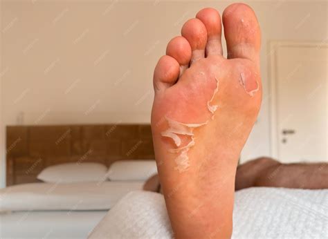 Premium Photo | Skin peels off a foot sweaty athlete foot skin peeling ...