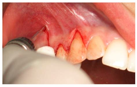 Laterally Positioned Flap Procedure with Augmented or Nonaugmented ...