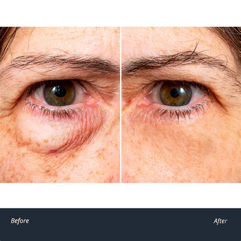 Baggy Eyes How To Reduce Puffy Eyes | SheerLuxe