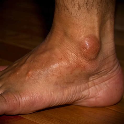 Ganglion Cyst | Teton Foot & Ankle Center