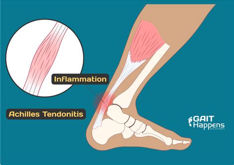 Know the Symptoms of Achilles Tendonitis / Tendinopathy | Gait Happens