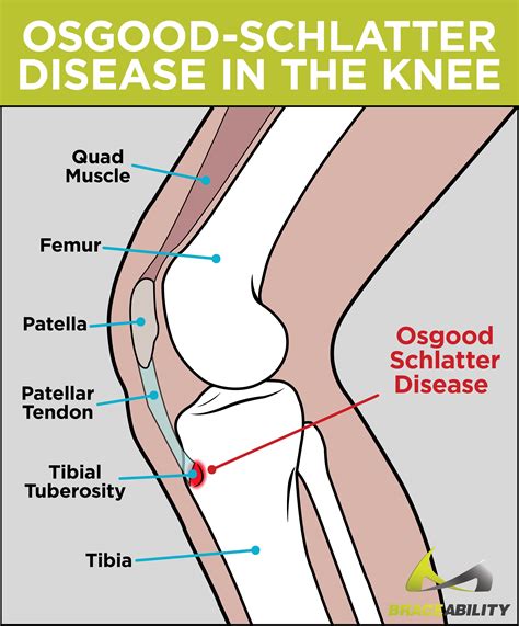 Treatment For Osgood Schlatter's Disease