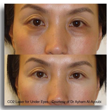 13 Procedures ideas | botox fillers, facial fillers, botox