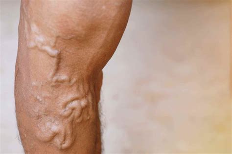 Varicose Veins Symptoms & Treatment | Vein Clinic Perth