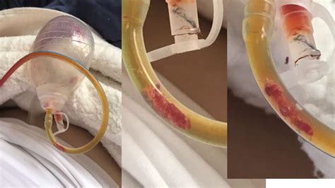 Jackson Pratt Drain Mastectomy