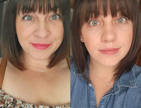 2 1/2 weeks post op! septoplasty (deviated septum), alar base reduction, tip refinement! almost ...