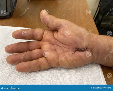 Man`s Swollen Hand. Carpal Tunnel Syndrome. Sutures after Surgery. Stock Photo - Image of ...