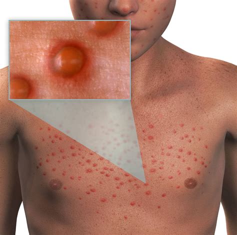 Chickenpox (varicella) - symptoms, treatment, vaccine | healthdirect
