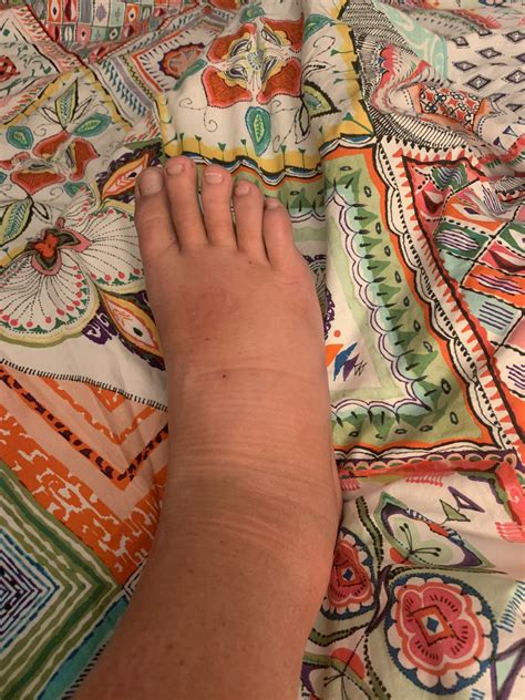 Swollen Feet In Spanish at Nelson Roberto blog