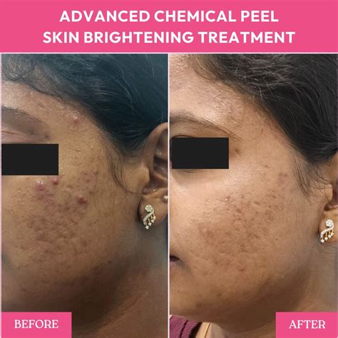 Chemical Peel Before and After Transform Your Skin