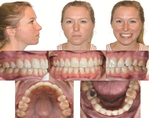 Progressive idiopathic condylar resorption: 6-year update - AJO-DO Clinical Companion
