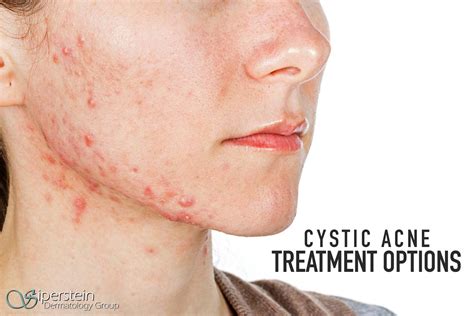 Makeup Cause Cystic Acne - Mugeek Vidalondon