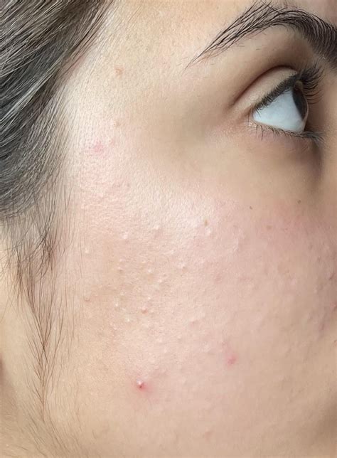 Fungal acne or closed comedones? : r/acne