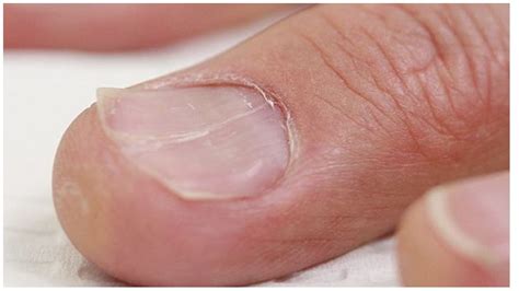 Iron Deficiency Nails Look Like at Hayden Marr blog